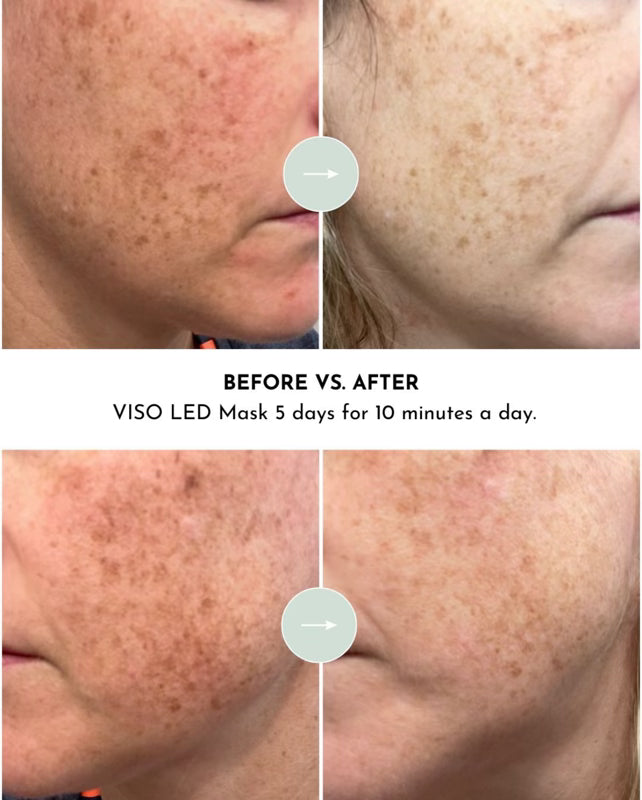 VISO - Mascarilla de terapia de luz roja certificada por la FDA